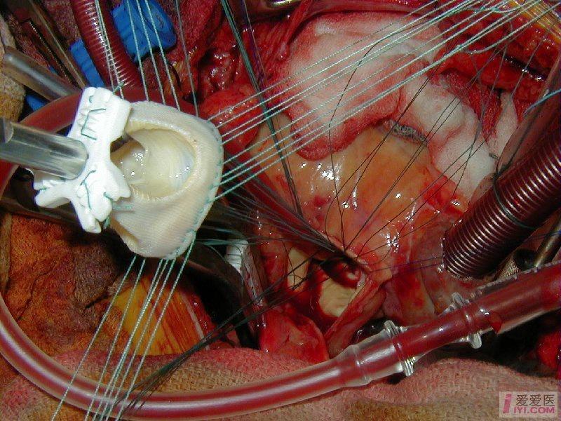 国外手术简介---主动脉瓣置换术 - 心血管内科资源版 - 爱爱医医学
